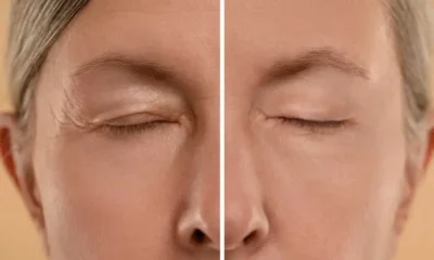 Sculptra Treatments