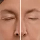 Sculptra Treatments