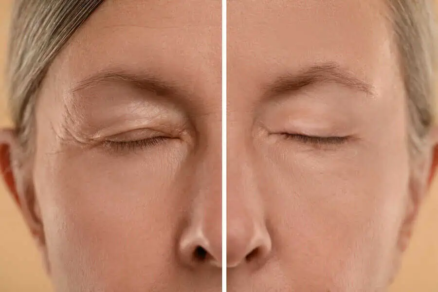 Sculptra Treatments